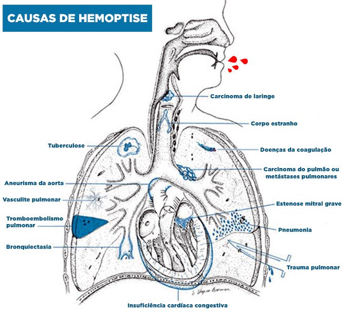 Hemoptise